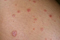 От инфекции до аллергии. Почему на коже появляются пятна